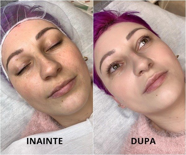 BB Glow — înainte și după